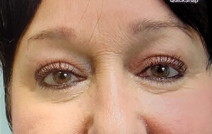 Blepharoplasty